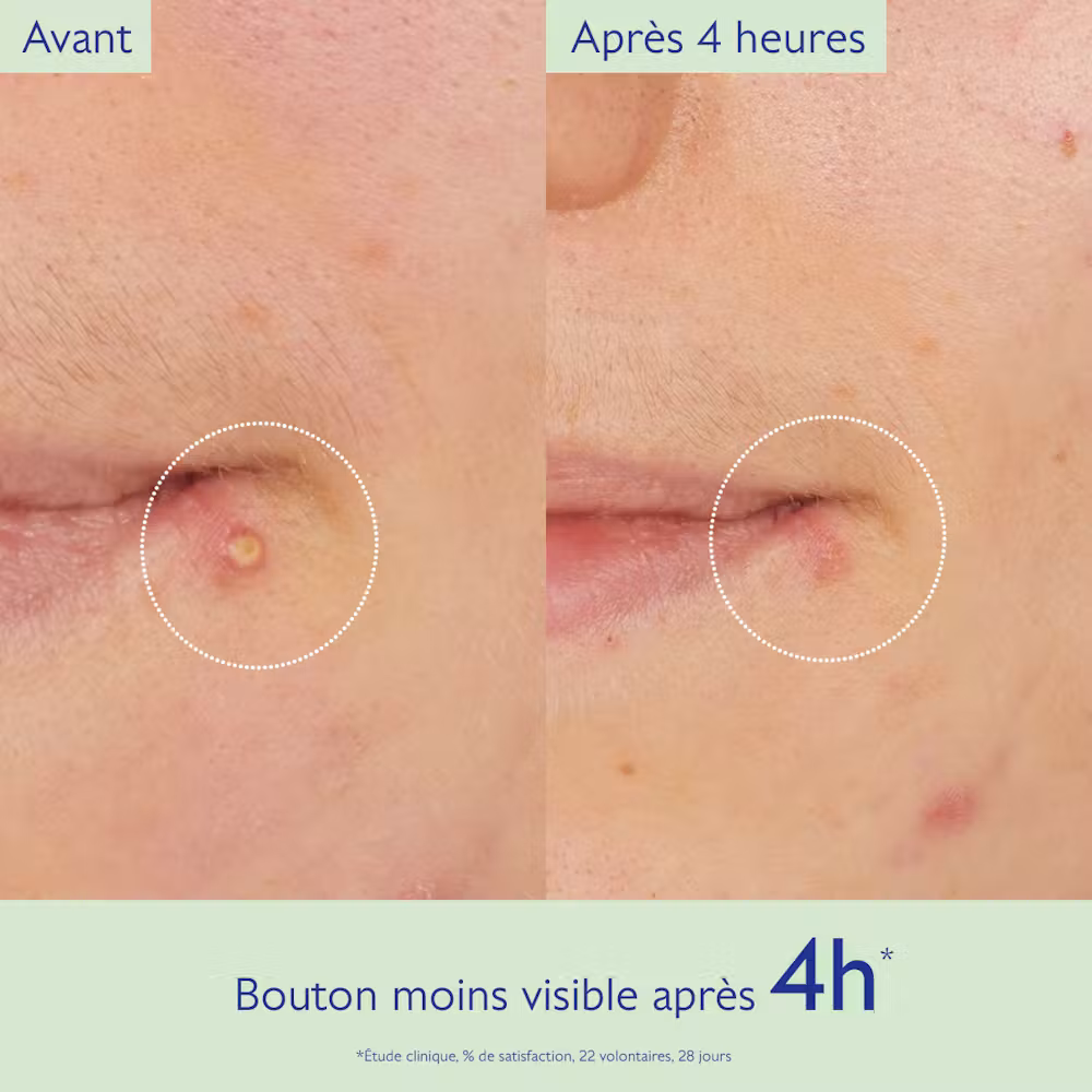 Stop Boutons Salicylique l'Acide Salicylique